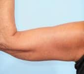 After Image: Arm Lift - back