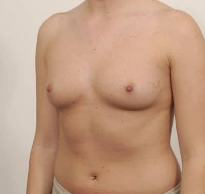 Before Image: Breast Augmentation - left-front-oblique