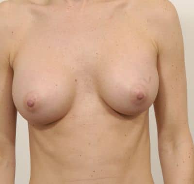 After Image: Breast Augmentation - front