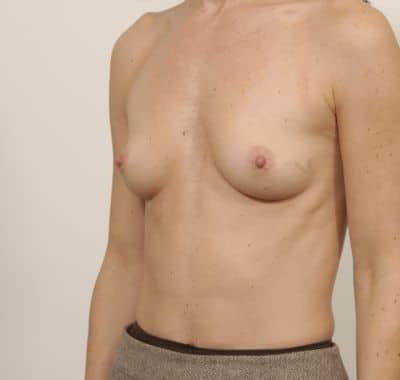Before Image: Breast Augmentation - left-front-oblique