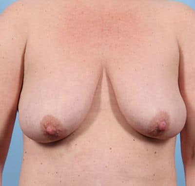 Before Image: Breast Lift - front