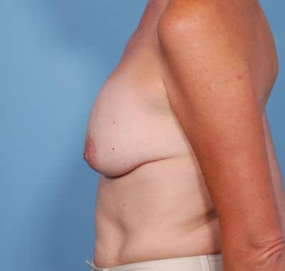Before Image: Breast Lift - left-side