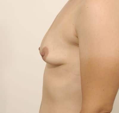 Before Image: Breast Lift - left-side