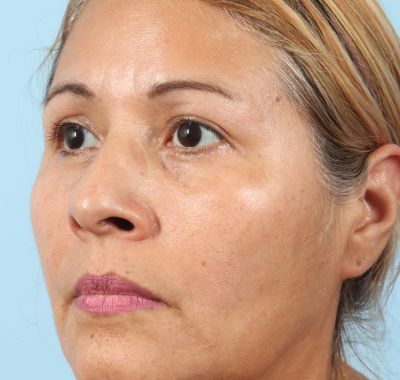 After Image: Brow, Eyes, Forehead - left-front-oblique