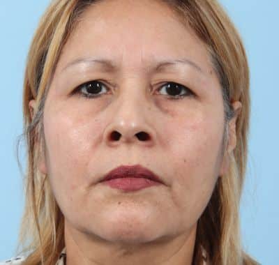 Before Image: Brow, Eyes, Forehead - front