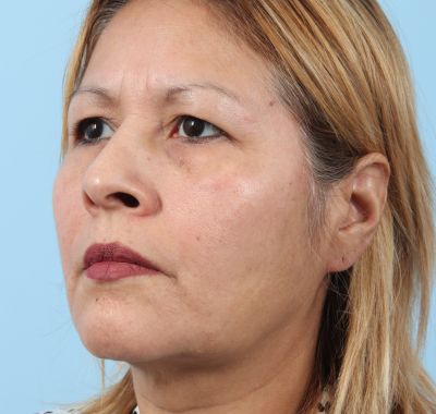 Before Image: Brow, Eyes, Forehead - left-front-oblique