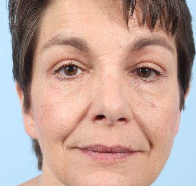 After Image: Brow, Eyes, Forehead - front