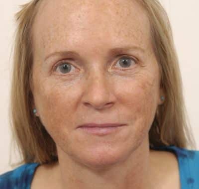 After Image: Brow, Eyes, Forehead - front