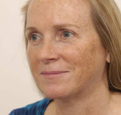 After Image: Brow, Eyes, Forehead - left-front-oblique