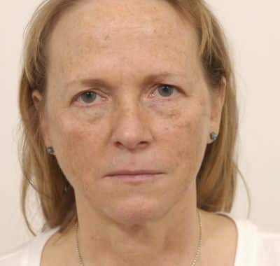 Before Image: Brow, Eyes, Forehead - front