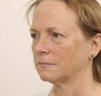 Before Image: Brow, Eyes, Forehead - left-front-oblique