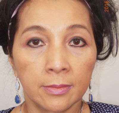 After Image: Brow, Eyes, Forehead - front