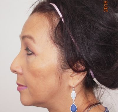 After Image: Brow, Eyes, Forehead - left-side