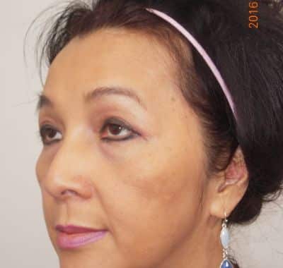 After Image: Brow, Eyes, Forehead - left-front-oblique