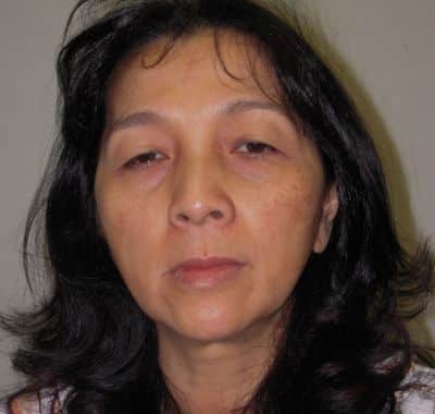 Before Image: Brow, Eyes, Forehead - front