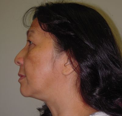 Before Image: Brow, Eyes, Forehead - left-side