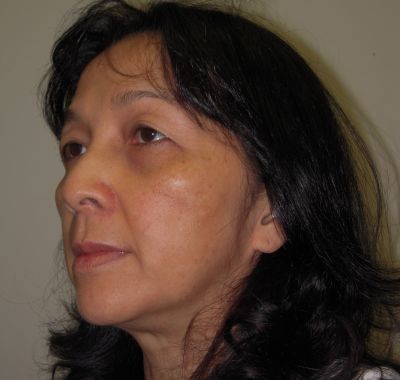 Before Image: Brow, Eyes, Forehead - left-front-oblique