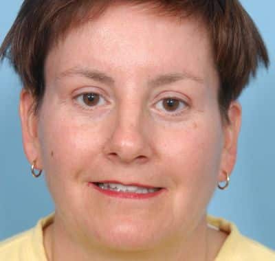 After Image: Brow, Eyes, Forehead - front