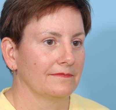 After Image: Brow, Eyes, Forehead - right-front-oblique