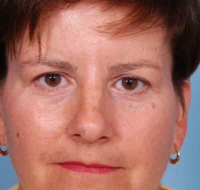 Before Image: Brow, Eyes, Forehead - front