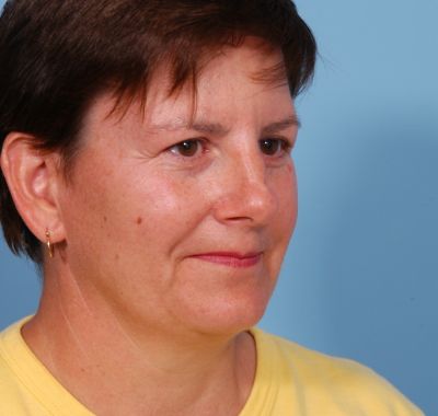 Before Image: Brow, Eyes, Forehead - right-front-oblique