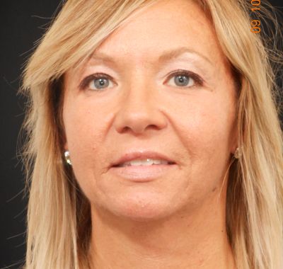 Before Image: Brow, Eyes, Forehead - front