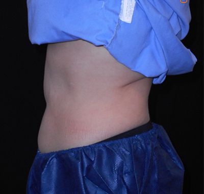 After Image: Coolsculpting - left-side