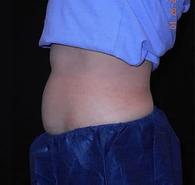 Before Image: Coolsculpting - left-side