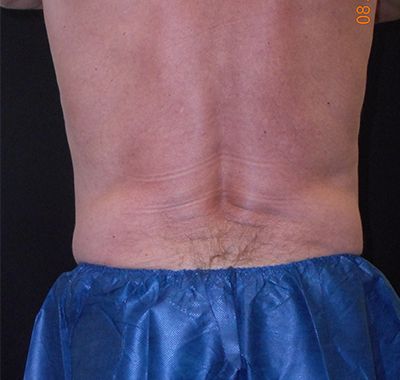After Image: Coolsculpting - back