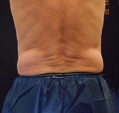 Before Image: Coolsculpting - back