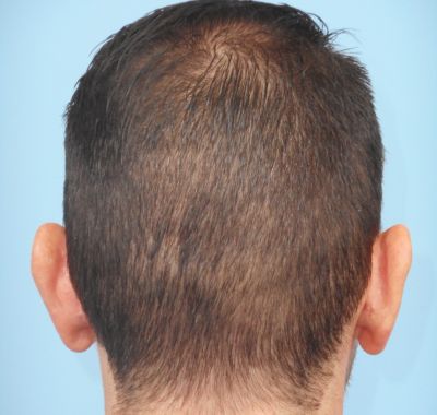 After Image: Ear Pinning - back