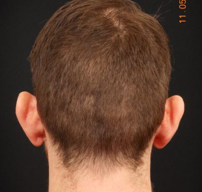 Before Image: Ear Pinning - back