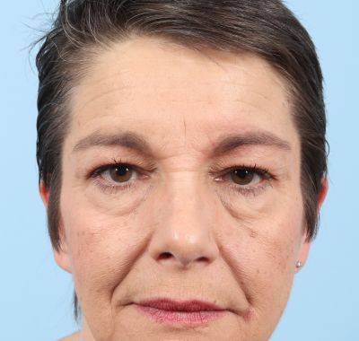 Before Image: Eyelift - front