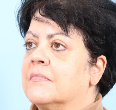 After Image: Eyelift - left-front-oblique