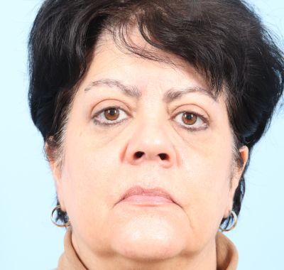 After Image: Eyelift - front