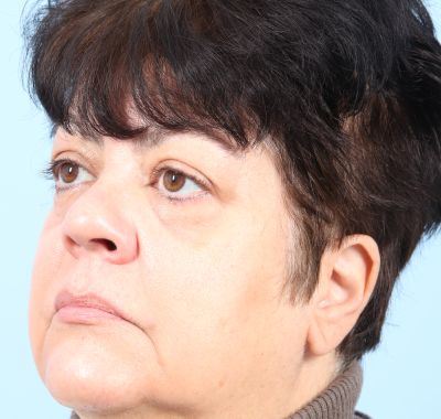 Before Image: Eyelift - left-front-oblique