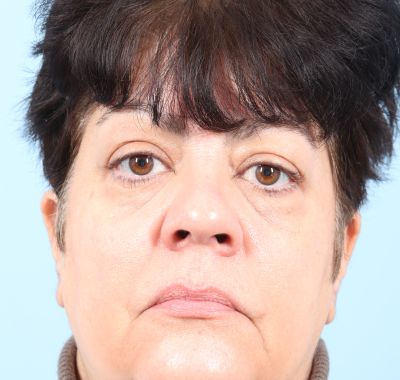 Before Image: Eyelift - front