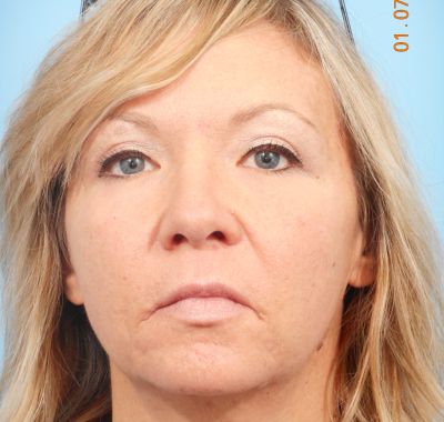 After Image: Eyelift - front