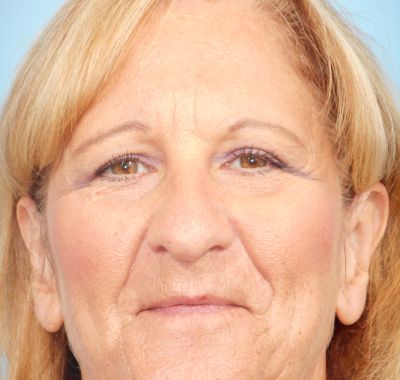 After Image: Eyelift - front