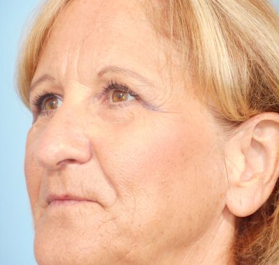 After Image: Eyelift - left-front-oblique