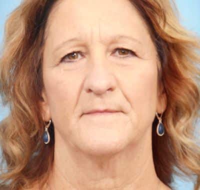 Before Image: Eyelift - front