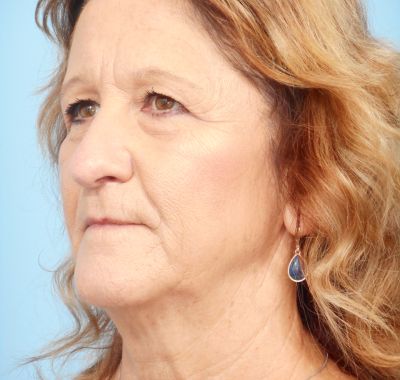 Before Image: Eyelift - left-front-oblique