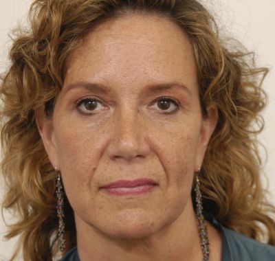 After Image: Eyelift - front