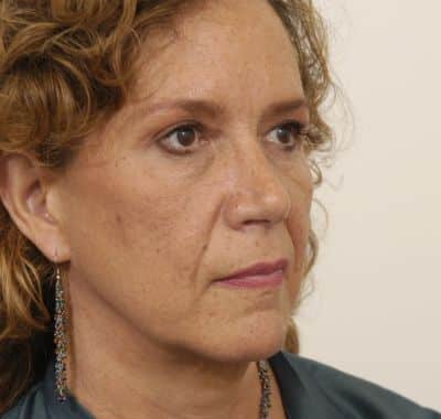 After Image: Eyelift - right-front-oblique