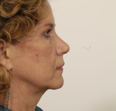 After Image: Eyelift - right-side