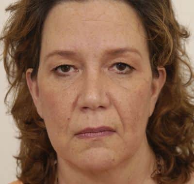 Before Image: Eyelift - front