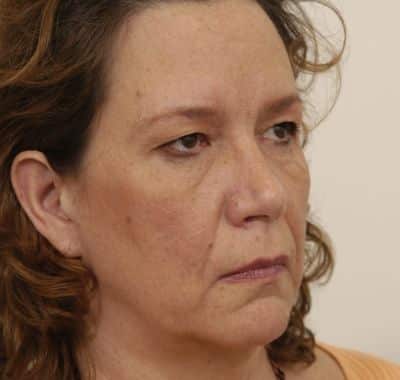 Before Image: Eyelift - right-front-oblique