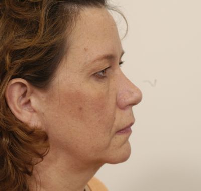 Before Image: Eyelift - right-side