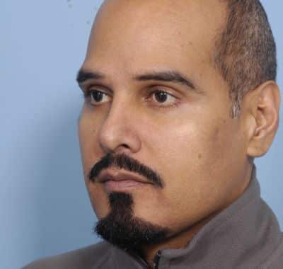 After Image: Eyelift - left-front-oblique