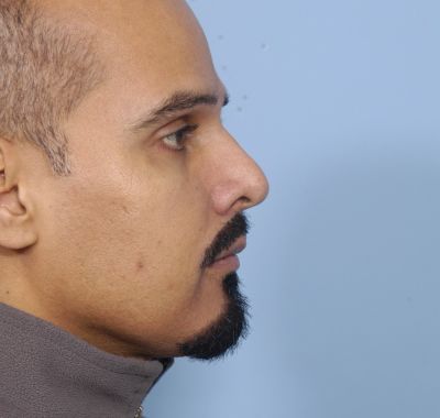 After Image: Eyelift - right-side